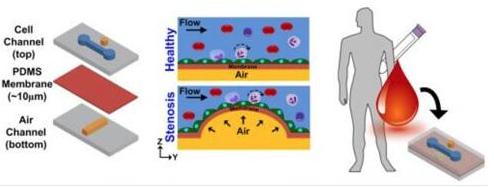 在芯片上實現動脈粥樣硬化的模擬,并在心臟病發作前評估血管的狹窄和血液的健康狀況 在芯片上實現動脈粥樣硬化的模擬,并在心臟病發作前評估血管的狹窄和血液的健康狀況