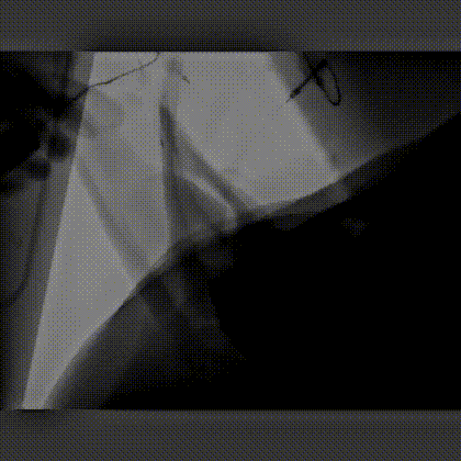 豬耳血管造影，可見枝枝杈杈很多