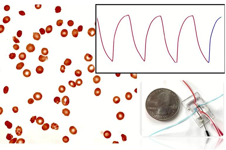 微流控阻抗傳感器可以監測鐮狀細胞病 微流控阻抗傳感器可以監測鐮狀細胞病