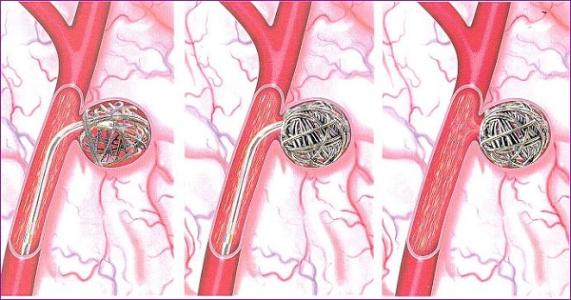 可拉伸的無線傳感器可以監測腦動脈瘤的愈合 可拉伸的無線傳感器可以監測腦動脈瘤的愈合