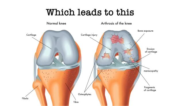 微流控“軟骨”芯片(Knee On Chip)用于關節炎研究 微流控“軟骨”芯片(Knee On Chip)用于關節炎研究