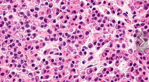 多發性骨髓瘤 多發性骨髓瘤